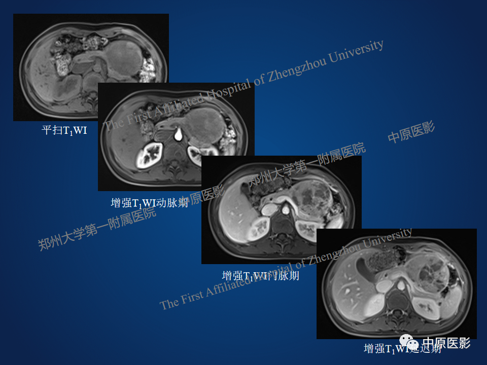 影像PPT - 【病例】胰腺实性假乳头状瘤1例MR-7