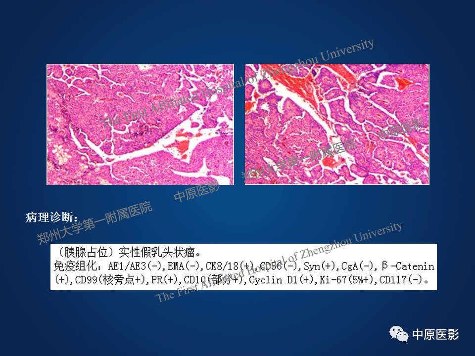 影像PPT - 【病例】胰腺实性假乳头状瘤1例MR-9