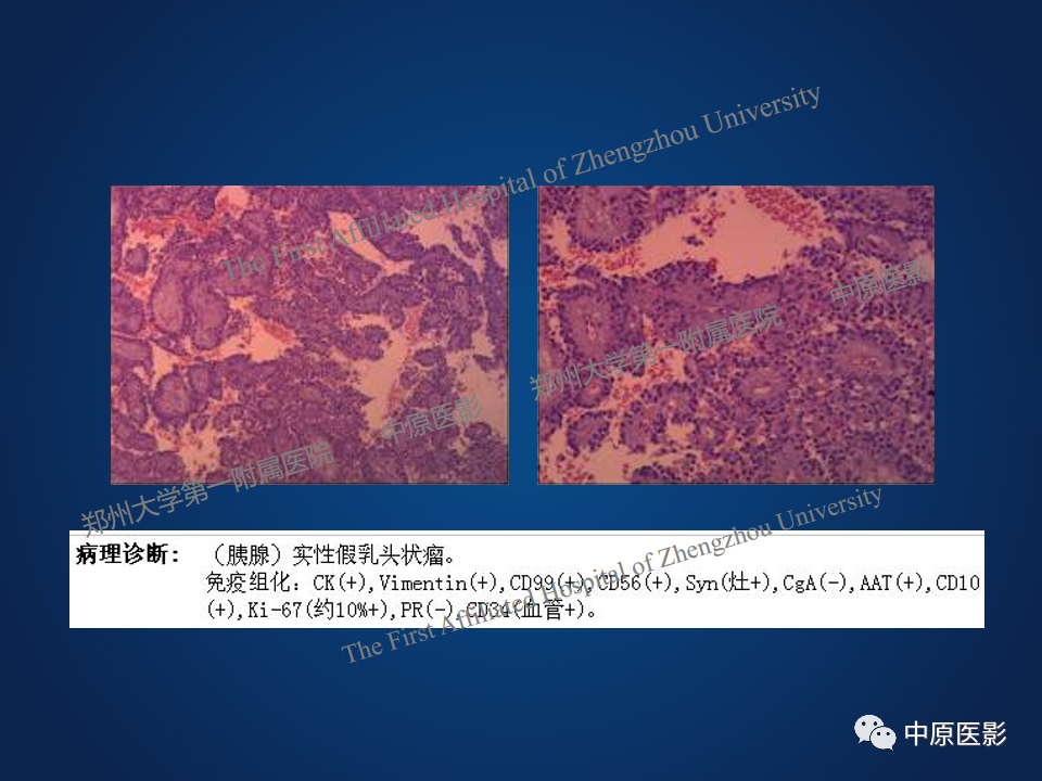 影像PPT - 【病例】胰腺实性假乳头状瘤1例MR-14