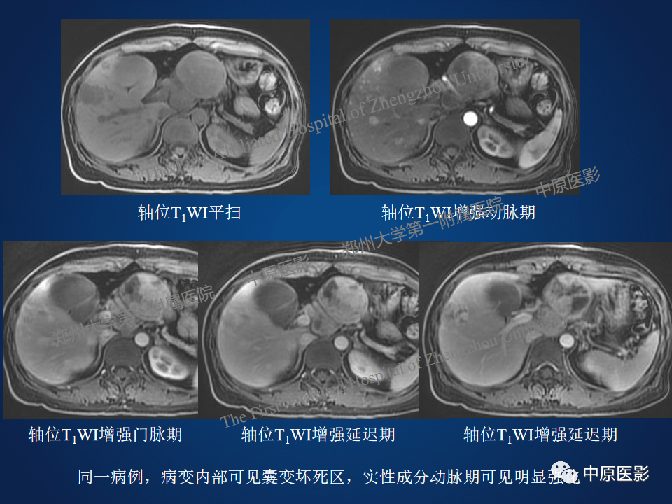 影像PPT - 【病例】胰腺实性假乳头状瘤1例MR-22