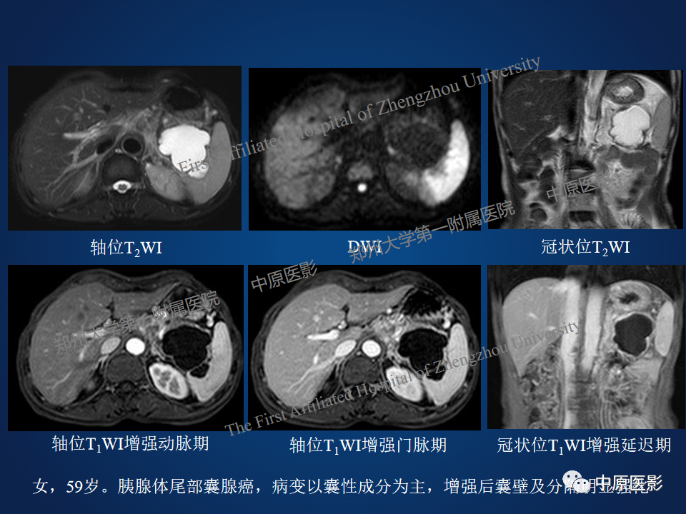 影像PPT - 【病例】胰腺实性假乳头状瘤1例MR-24