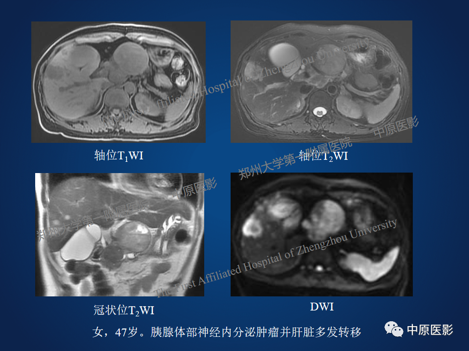 影像PPT - 【病例】胰腺实性假乳头状瘤1例MR-21