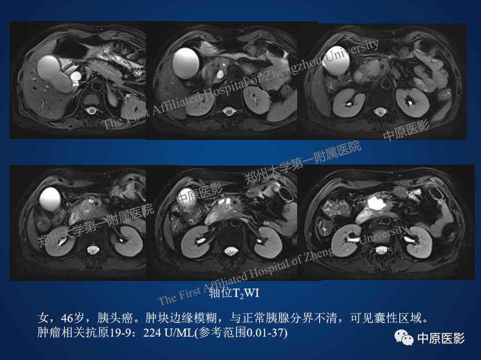 影像PPT - 【病例】胰腺实性假乳头状瘤1例MR-26