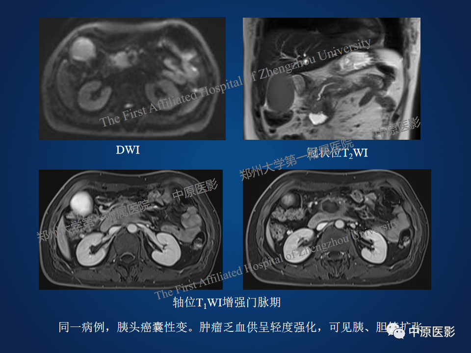 影像PPT - 【病例】胰腺实性假乳头状瘤1例MR-27