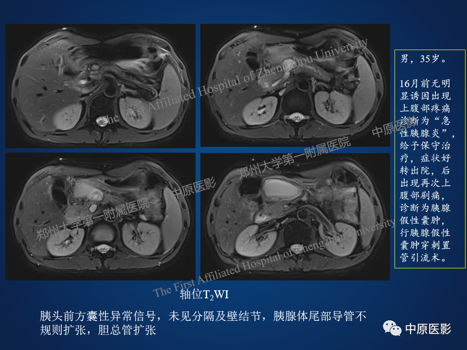 影像PPT - 【病例】胰腺实性假乳头状瘤1例MR-29