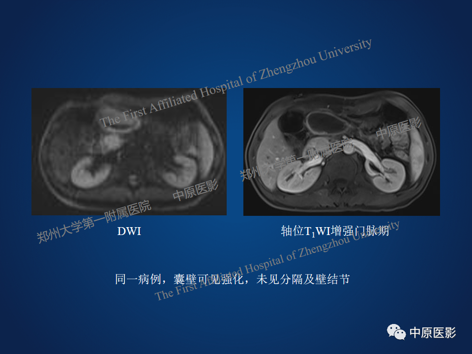 影像PPT - 【病例】胰腺实性假乳头状瘤1例MR-30