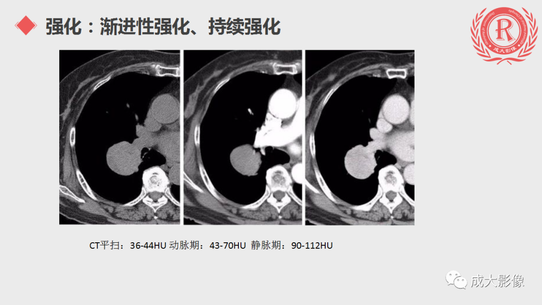 影像PPT - 【PPT】肺硬化性血管瘤-12