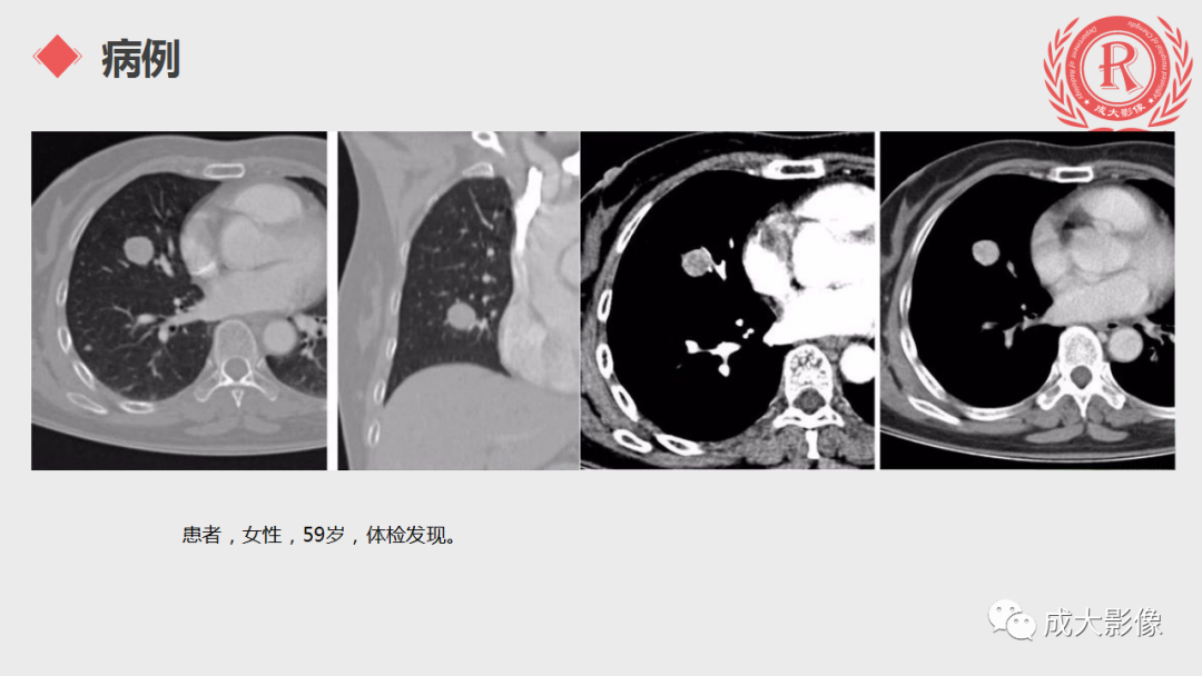 影像PPT - 【PPT】肺硬化性血管瘤-14