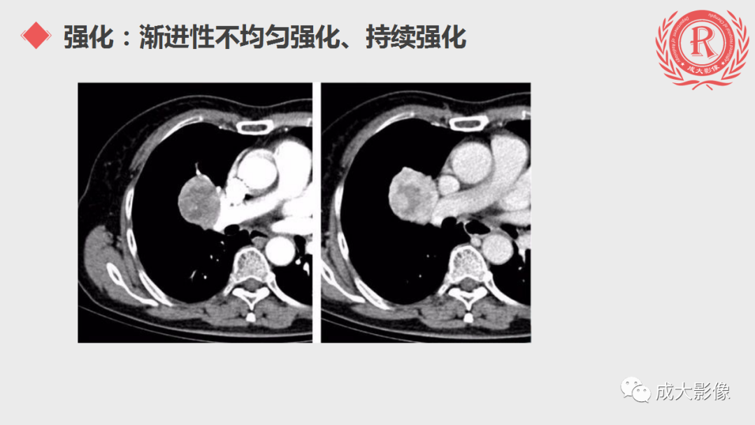 影像PPT - 【PPT】肺硬化性血管瘤-13