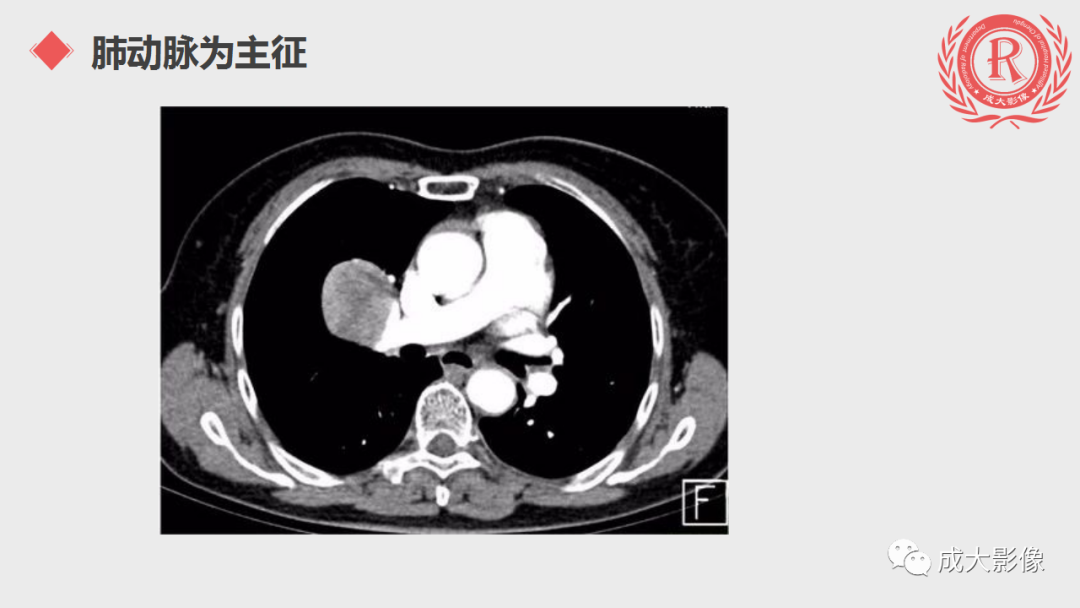 影像PPT - 【PPT】肺硬化性血管瘤-11