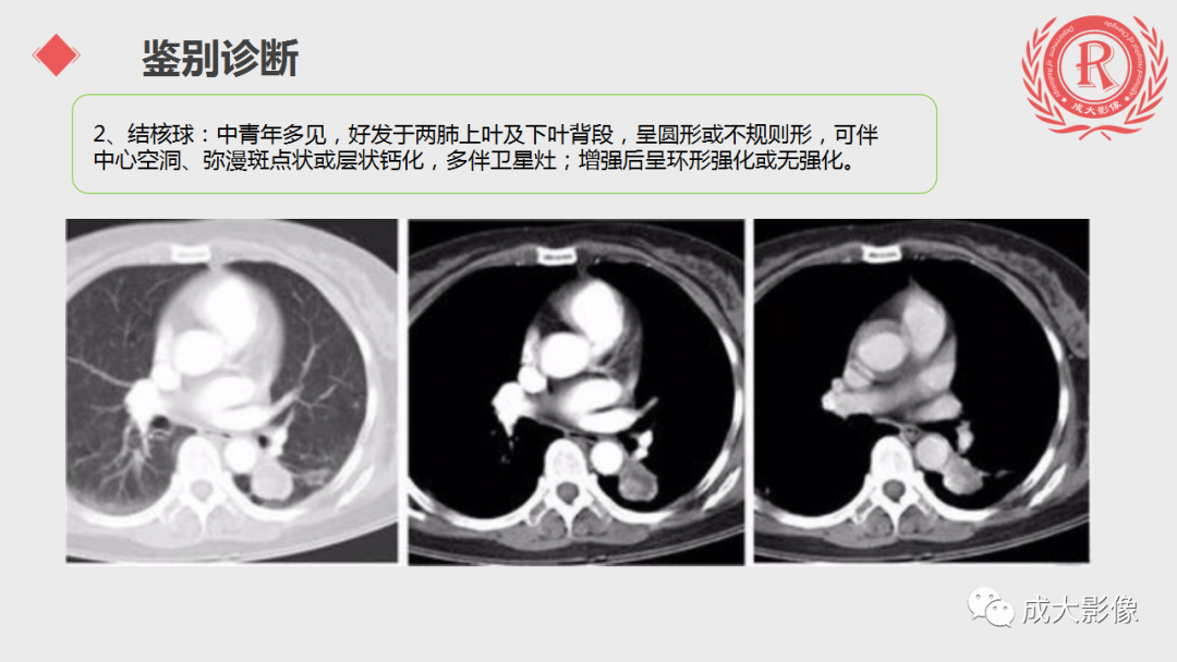 影像PPT - 【PPT】肺硬化性血管瘤-16