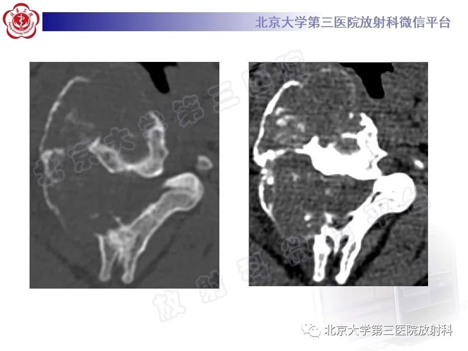 影像PPT - 【PPT】软骨母细胞瘤-4