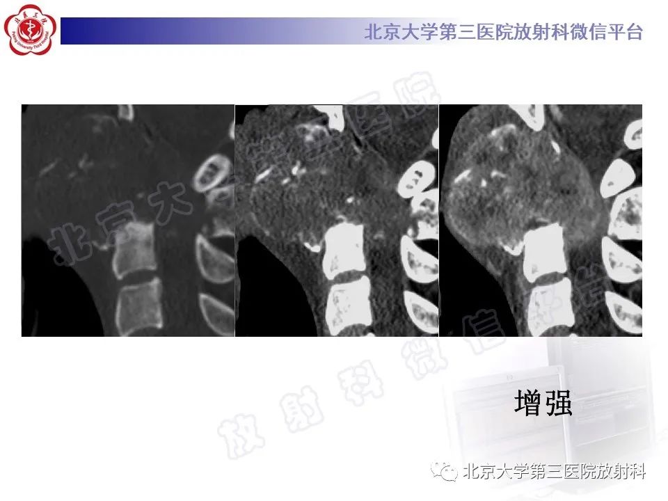 影像PPT - 【PPT】软骨母细胞瘤-5