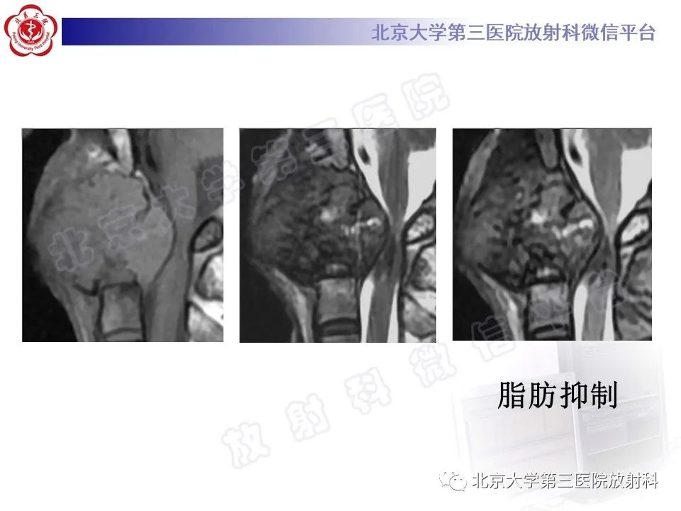 影像PPT - 【PPT】软骨母细胞瘤-6