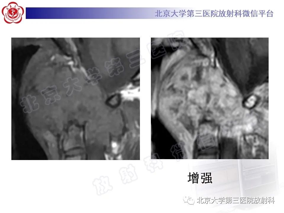 影像PPT - 【PPT】软骨母细胞瘤-9