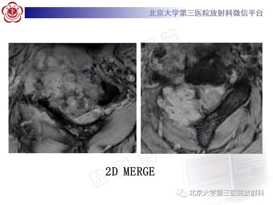 影像PPT - 【PPT】软骨母细胞瘤-7
