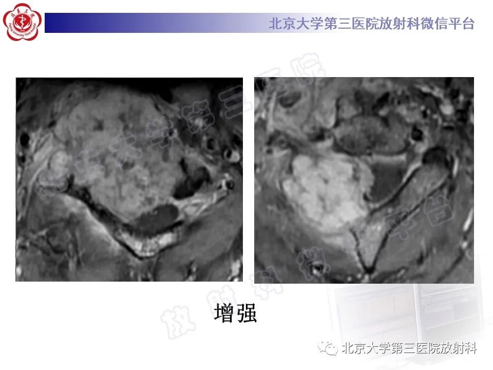 影像PPT - 【PPT】软骨母细胞瘤-8