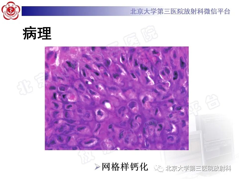 影像PPT - 【PPT】软骨母细胞瘤-21