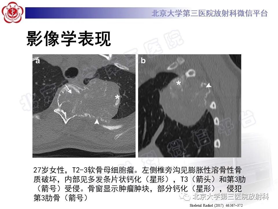 影像PPT - 【PPT】软骨母细胞瘤-25