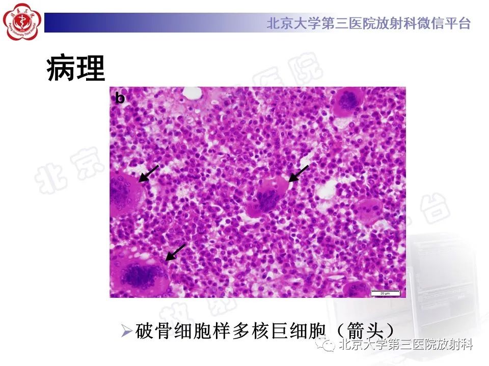 影像PPT - 【PPT】软骨母细胞瘤-20