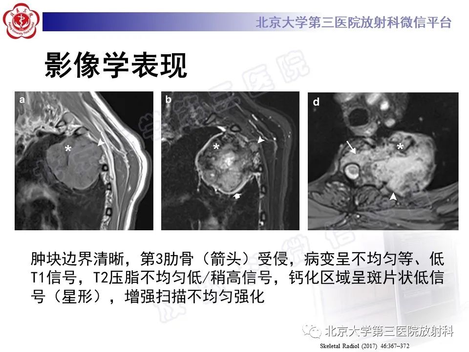 影像PPT - 【PPT】软骨母细胞瘤-26