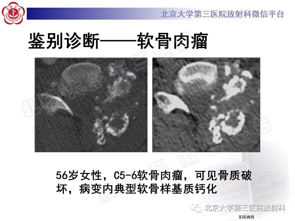 影像PPT - 【PPT】软骨母细胞瘤-29