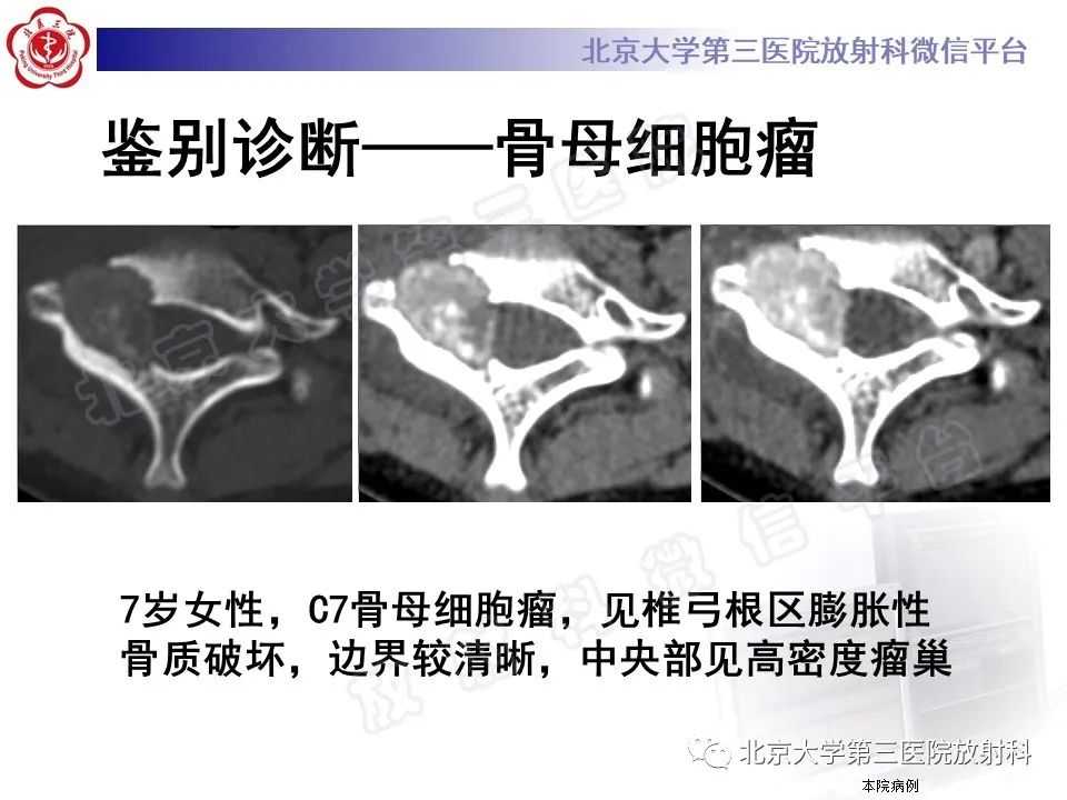 影像PPT - 【PPT】软骨母细胞瘤-32