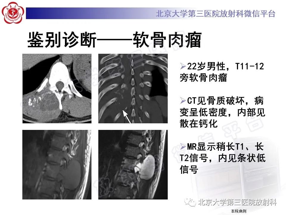 影像PPT - 【PPT】软骨母细胞瘤-30
