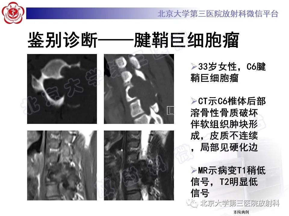 影像PPT - 【PPT】软骨母细胞瘤-34