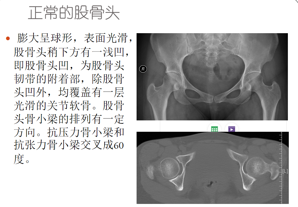 影像PPT - 【PPT】骨缺血坏死的影像诊断-6