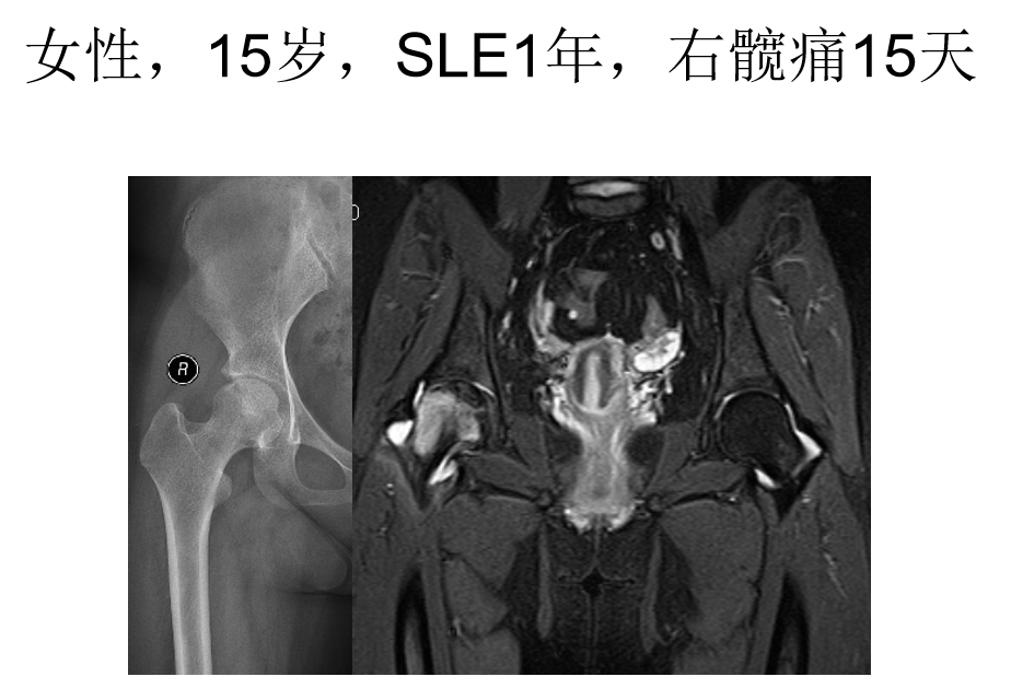 影像PPT - 【PPT】骨缺血坏死的影像诊断-15