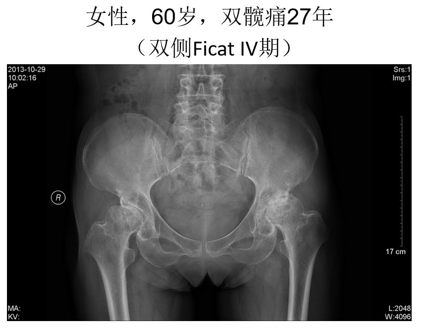影像PPT - 【PPT】骨缺血坏死的影像诊断-17