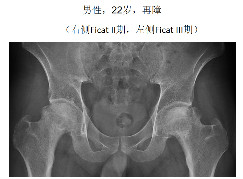 影像PPT - 【PPT】骨缺血坏死的影像诊断-16