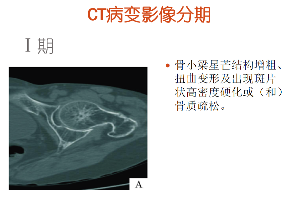 影像PPT - 【PPT】骨缺血坏死的影像诊断-19