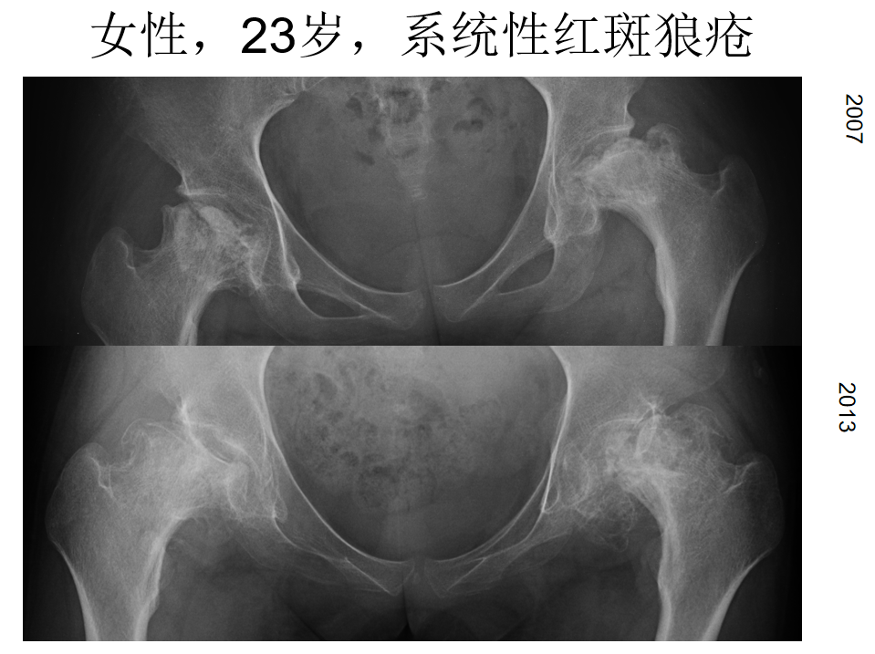 影像PPT - 【PPT】骨缺血坏死的影像诊断-18