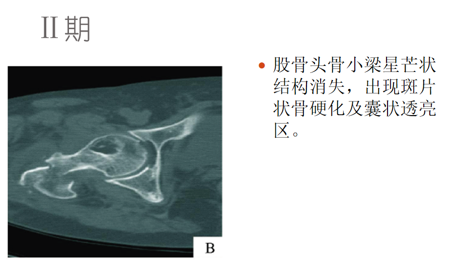 影像PPT - 【PPT】骨缺血坏死的影像诊断-20