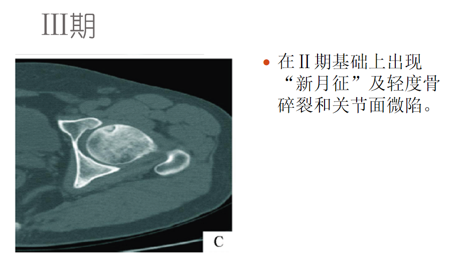 影像PPT - 【PPT】骨缺血坏死的影像诊断-21