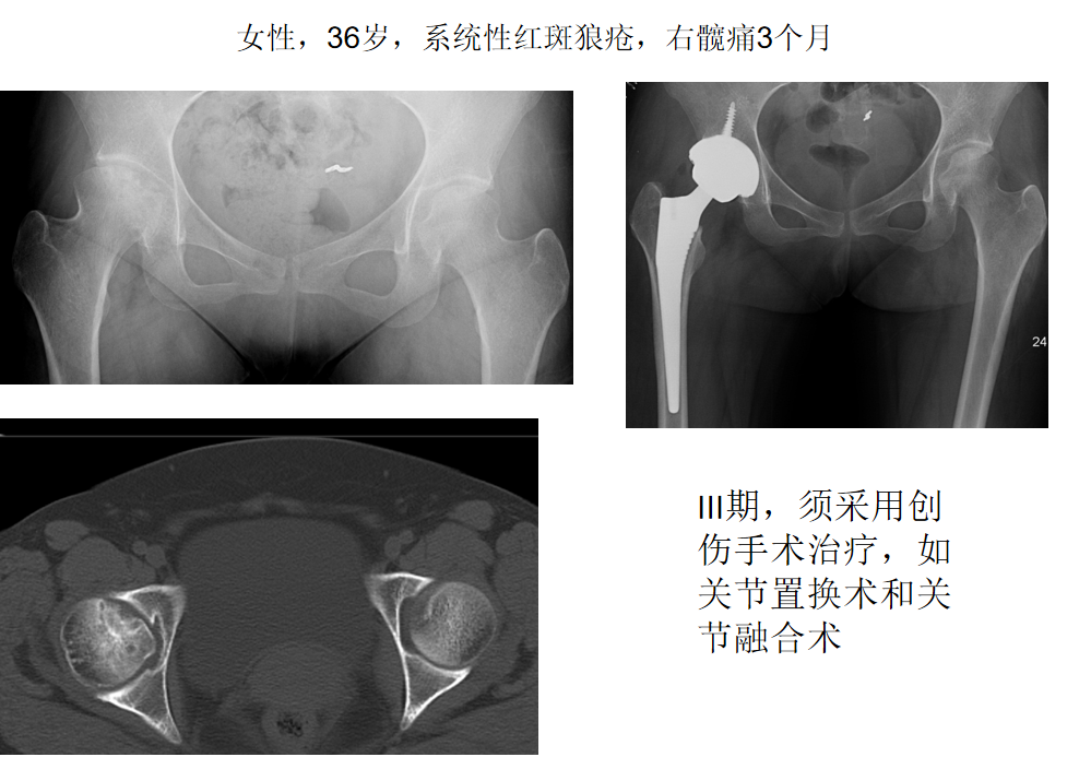 影像PPT - 【PPT】骨缺血坏死的影像诊断-22