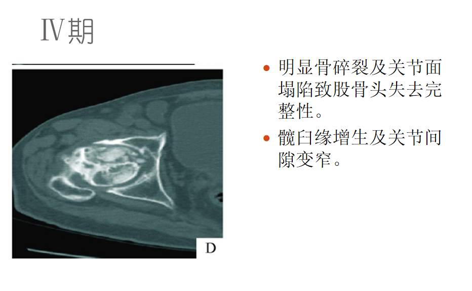 影像PPT - 【PPT】骨缺血坏死的影像诊断-23