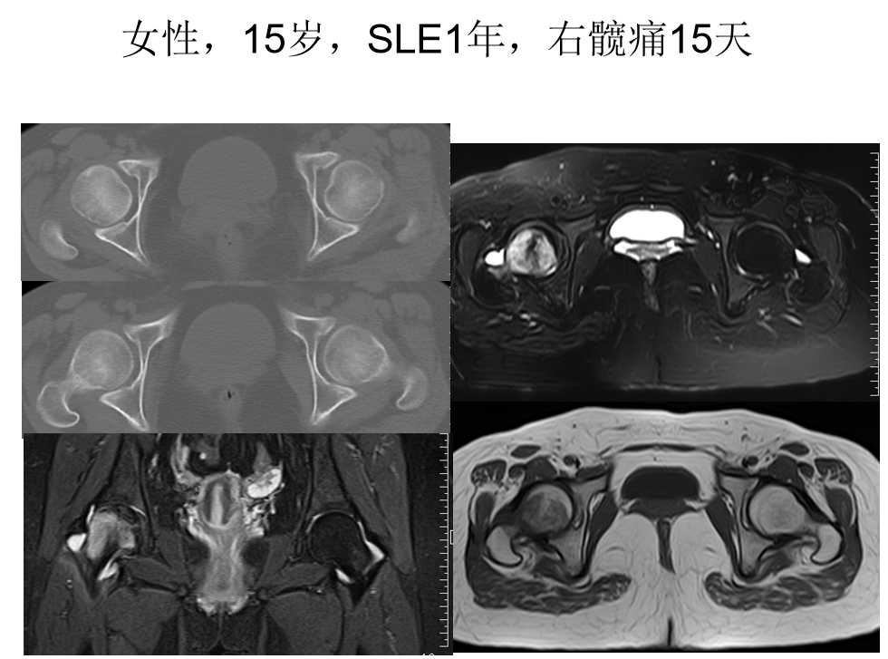 影像PPT - 【PPT】骨缺血坏死的影像诊断-26