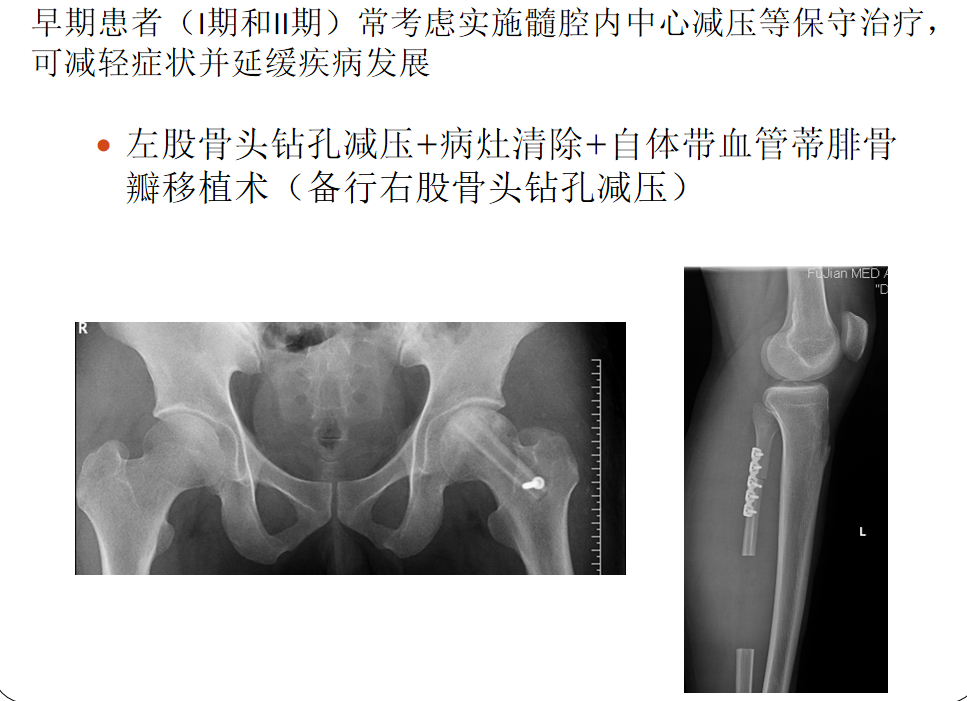 影像PPT - 【PPT】骨缺血坏死的影像诊断-28