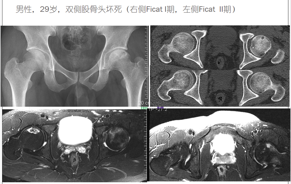 影像PPT - 【PPT】骨缺血坏死的影像诊断-27