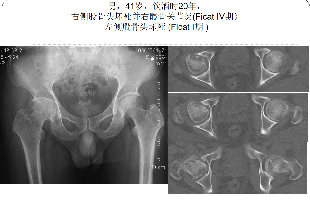 影像PPT - 【PPT】骨缺血坏死的影像诊断-30