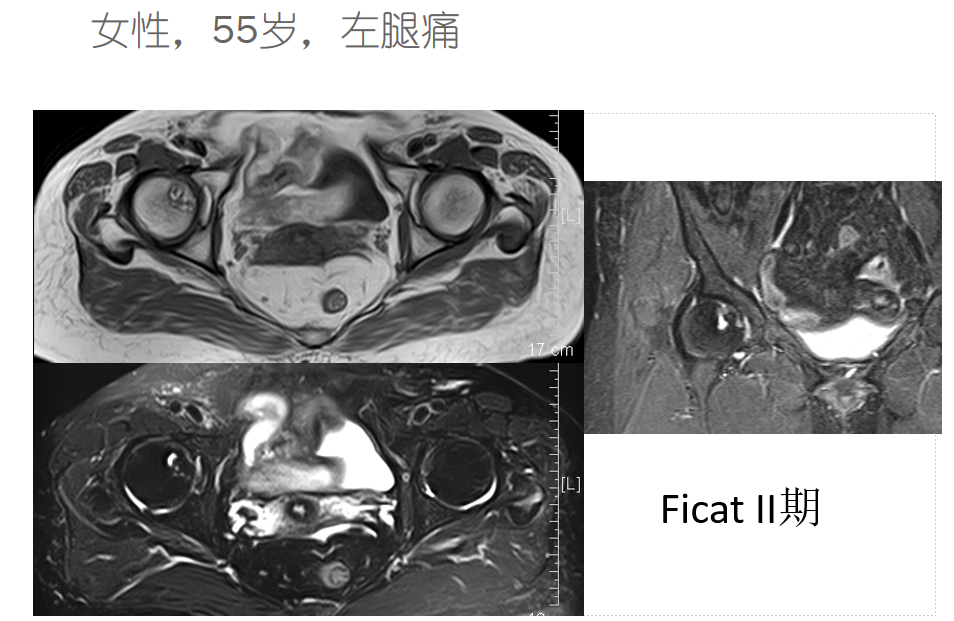 影像PPT - 【PPT】骨缺血坏死的影像诊断-29