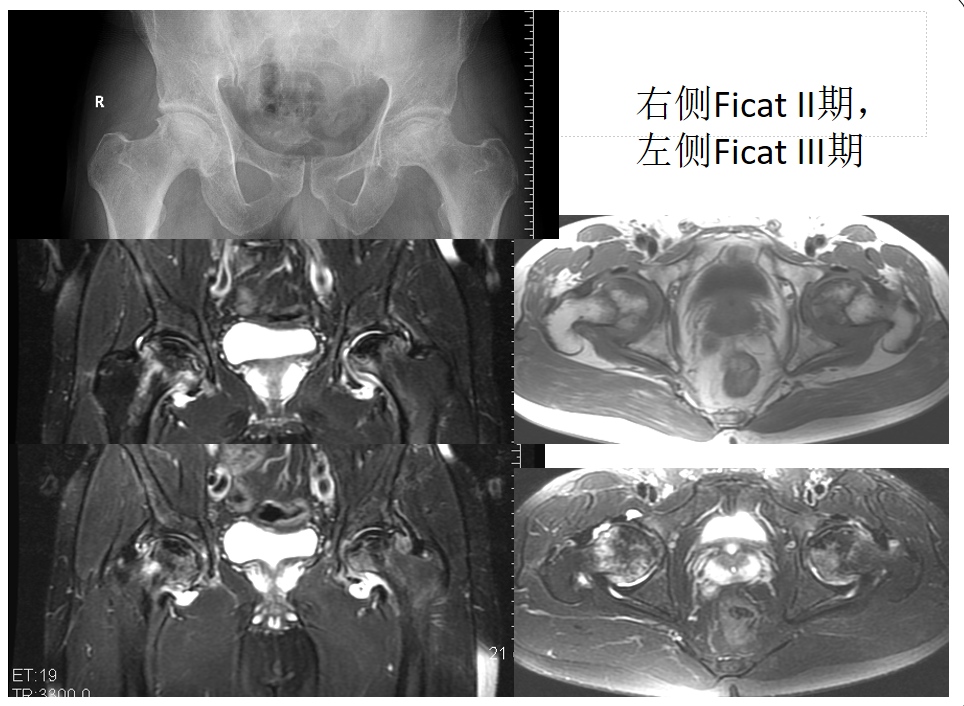 影像PPT - 【PPT】骨缺血坏死的影像诊断-32