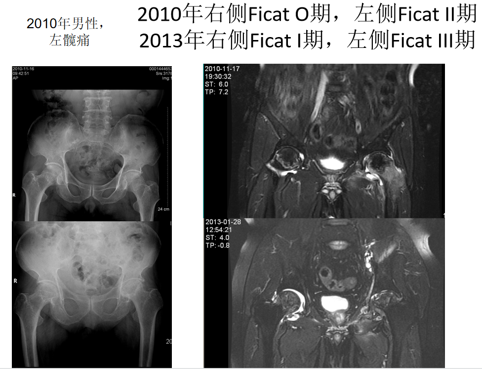 影像PPT - 【PPT】骨缺血坏死的影像诊断-33