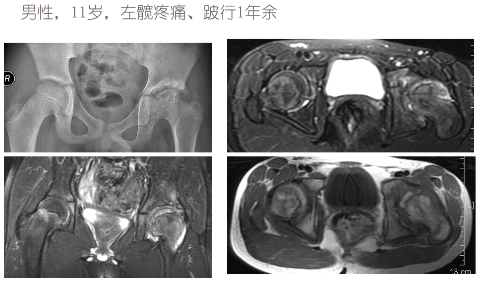 影像PPT - 【PPT】骨缺血坏死的影像诊断-34