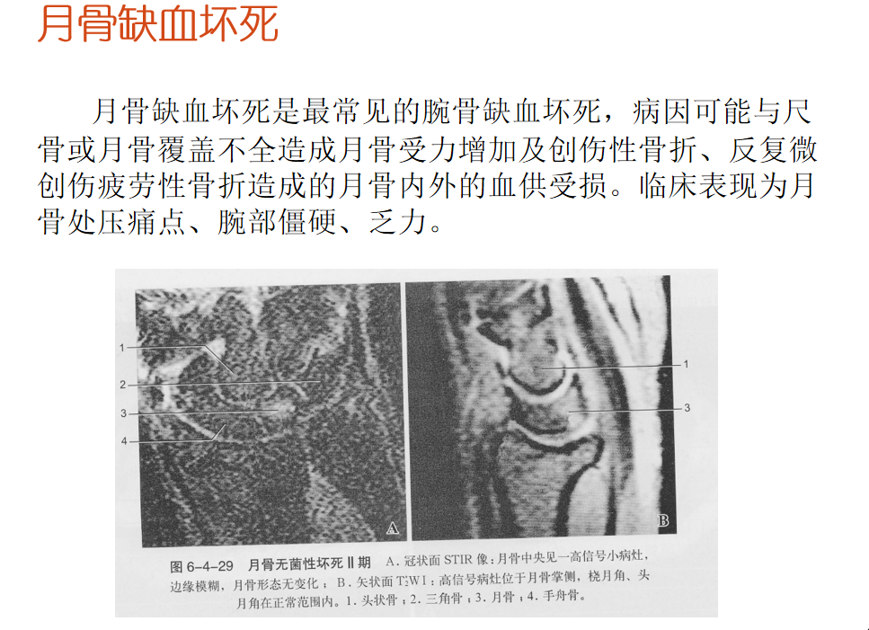 影像PPT - 【PPT】骨缺血坏死的影像诊断-35