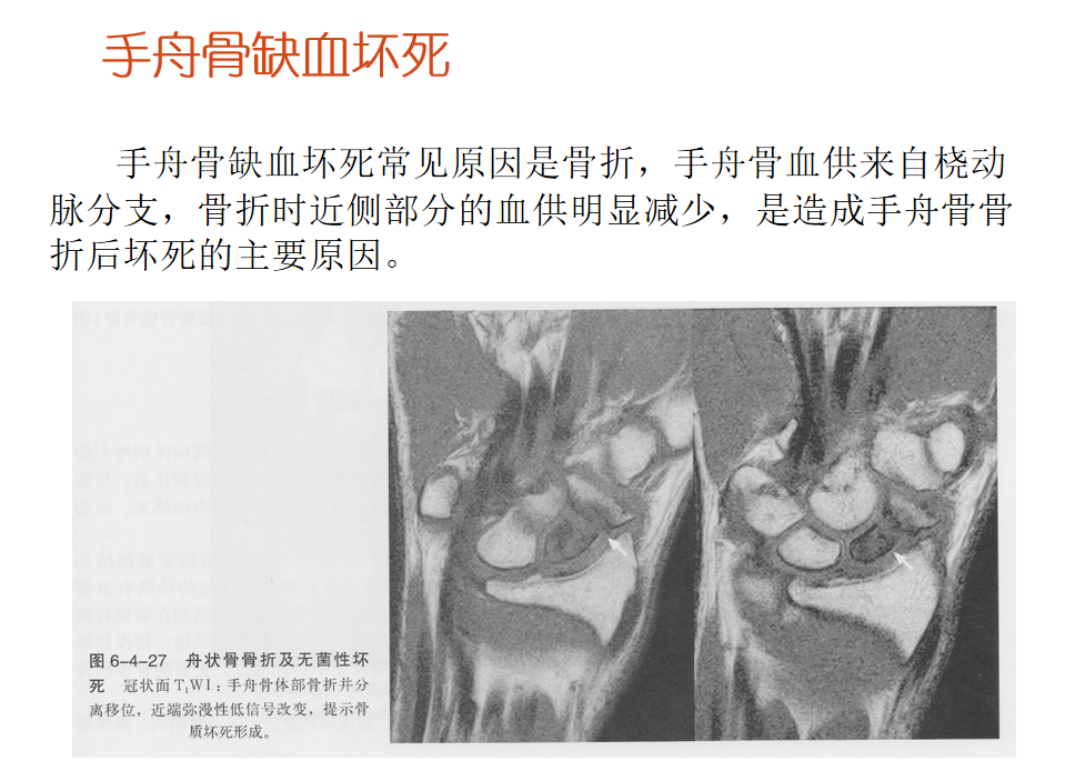 影像PPT - 【PPT】骨缺血坏死的影像诊断-36