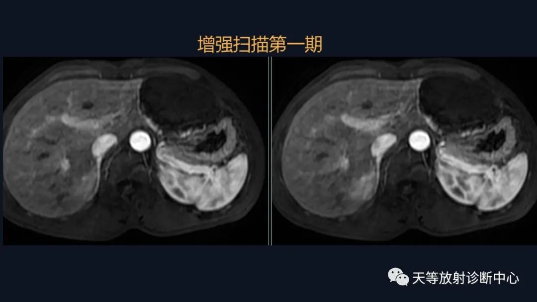 影像PPT - 带你认识灯泡征+早出晚归-11 影像PPT - 带你认识灯泡征+早出晚归-11